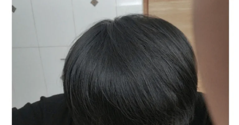 모발이식에 천만원 투자한 38살 결과물