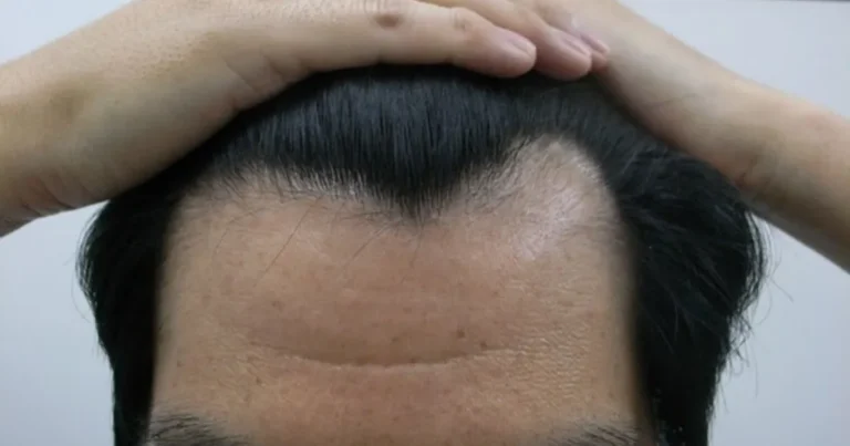 ”밤에 머리 감지마세요” 감을 수록 탈모 증상이 3배 증가됩니다.