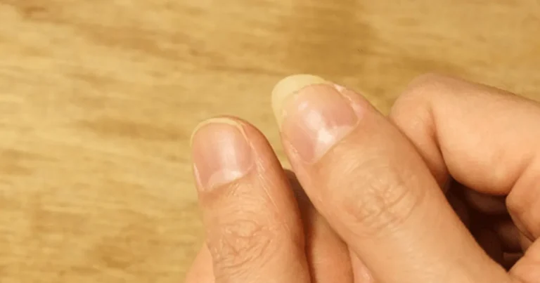 만약 손톱에 “이런 증상” 보인다면 혈액 속 단백질 전부 빠져나가는 겁니다.