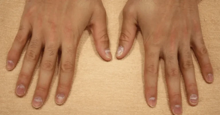 손톱에 “이걸 했다면 암세포를 붙인 겁니다” 절대 하지 마세요