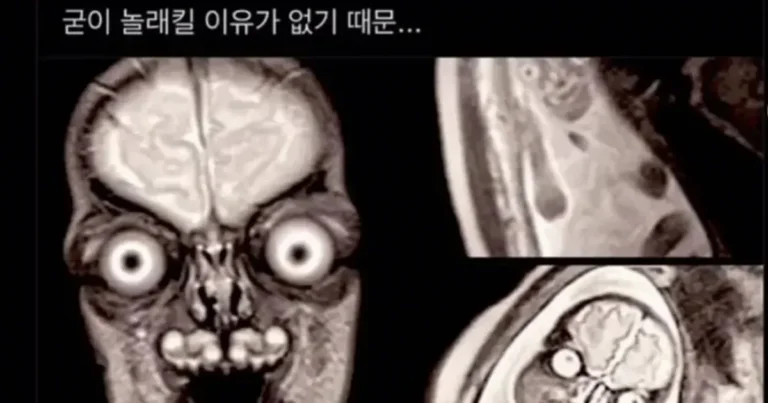 임산부 MRI를 안하는이유